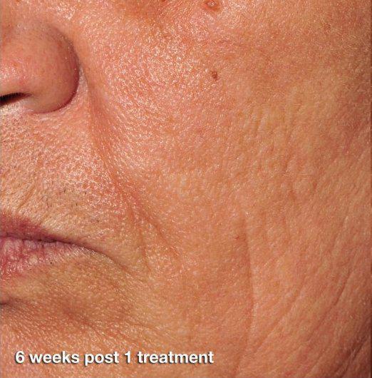 Results 6 weeks after 1 skin rejuvenation treatment at advanced rejuvenation centers.