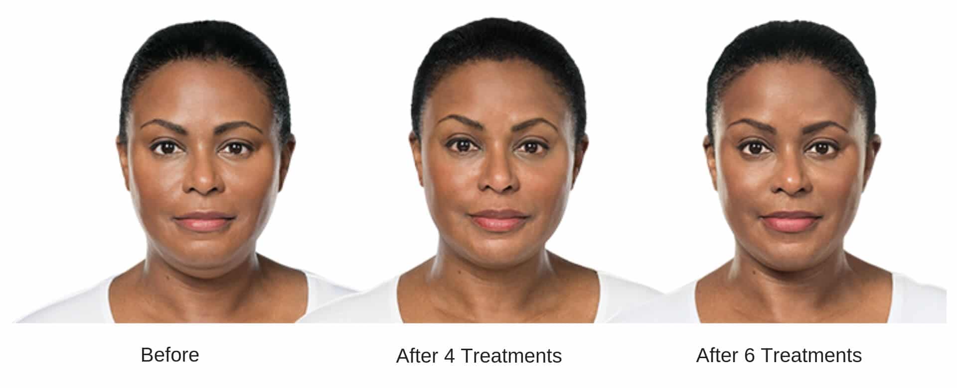 Womans before and after 6 treatment results from Kybella.