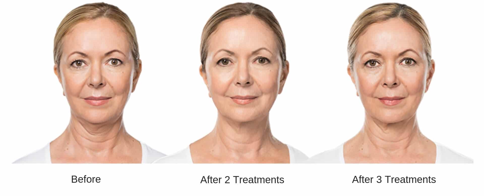 Womans before and after 6 treatment results from Kybella.