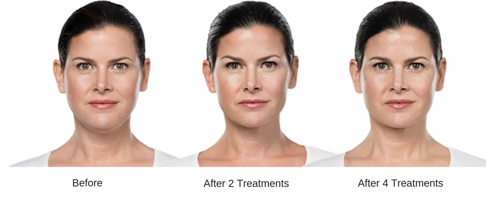 Womans before and after 6 treatment results from Kybella.