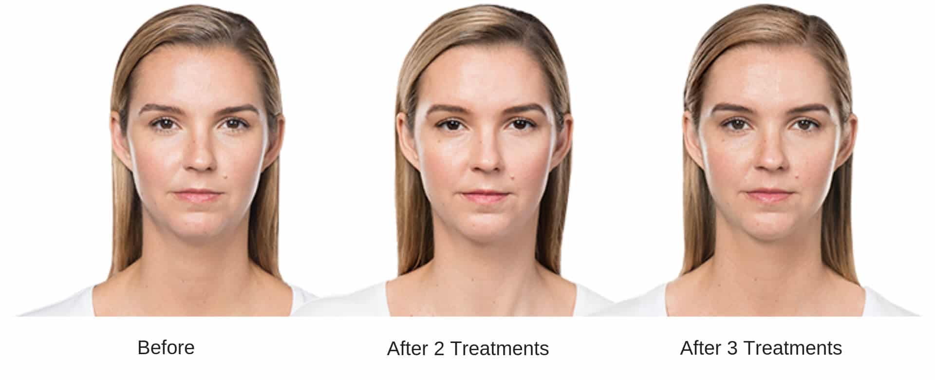 Womans before and after 6 treatment results from Kybella.