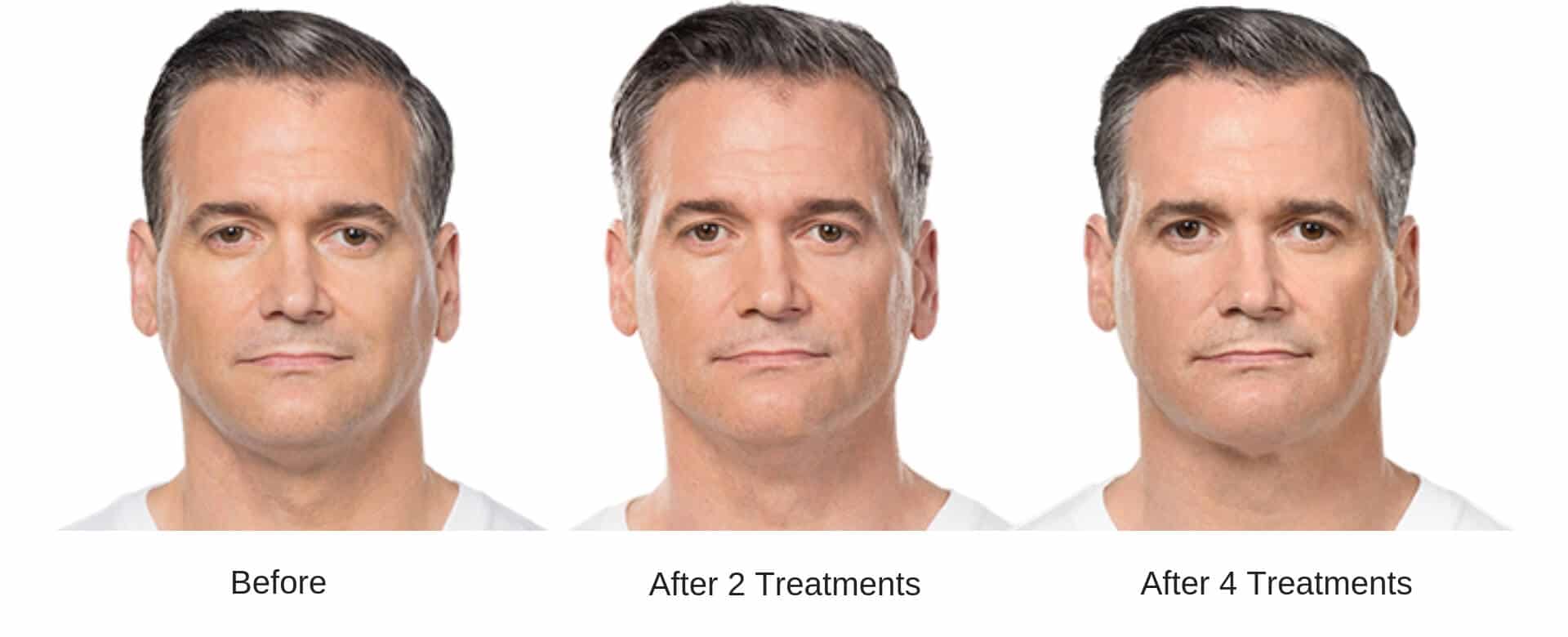 Mans before and after 6 treatment results from Kybella.