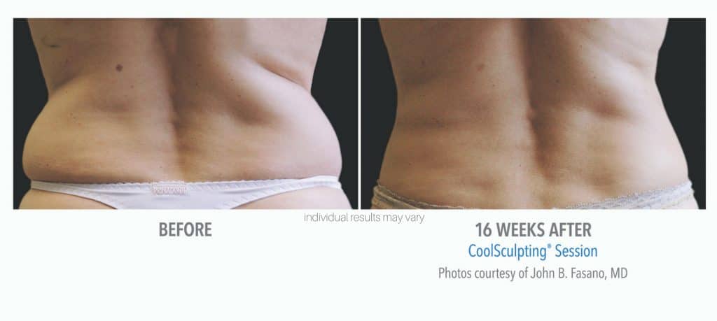 Back fat reduction before and 16 weeks after coolsculpting results, treatment done at advanced rejuvenation centers.