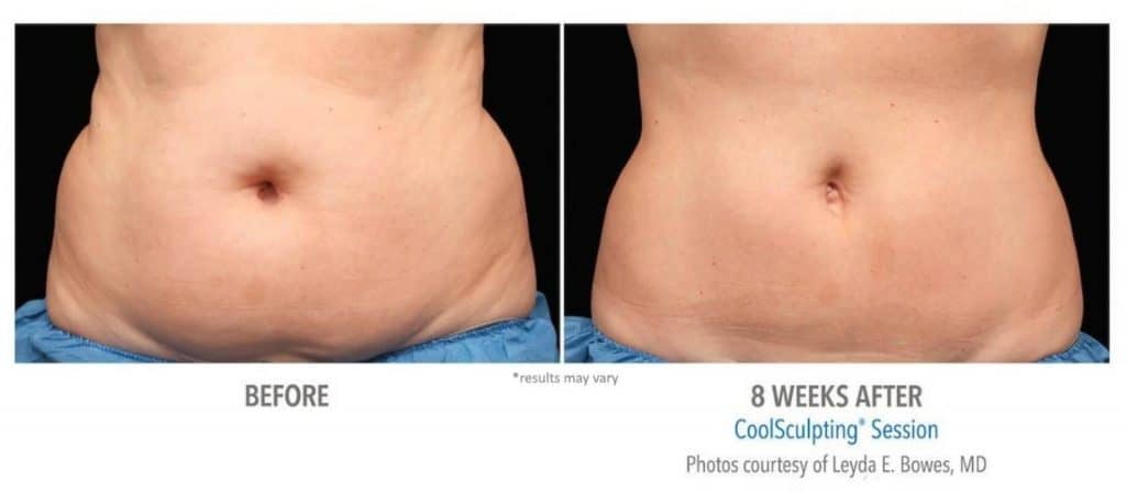 Abdomen before and 8 weeks after coolsculpting results, treatment done at Advanced Rejuvenation Centers.