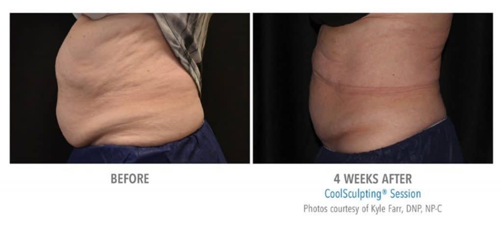 Abdomen before and 4 weeks after Coolsculpting treatment done at Advanced Rejuvenation centers.