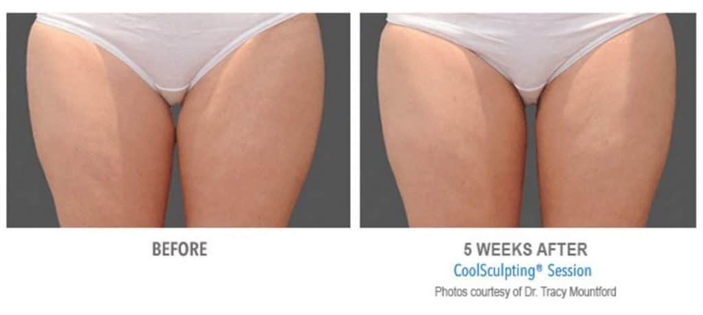 Womans before and 5 weeks after coolsculpting treatment to the thighs done at advanced rejuvenation centers.