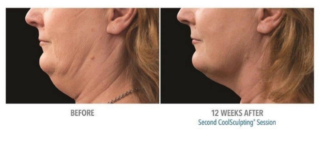Woman's chin before and after coolsculpting treatment at Advanced Rejuvenation Centers.