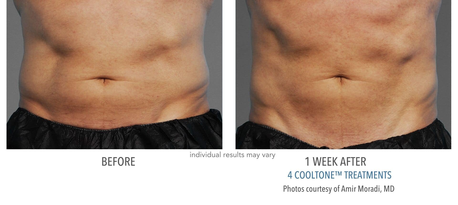 Mans abdomen one week difference before and after cooltone treatment at advanced rejuvenation centers.