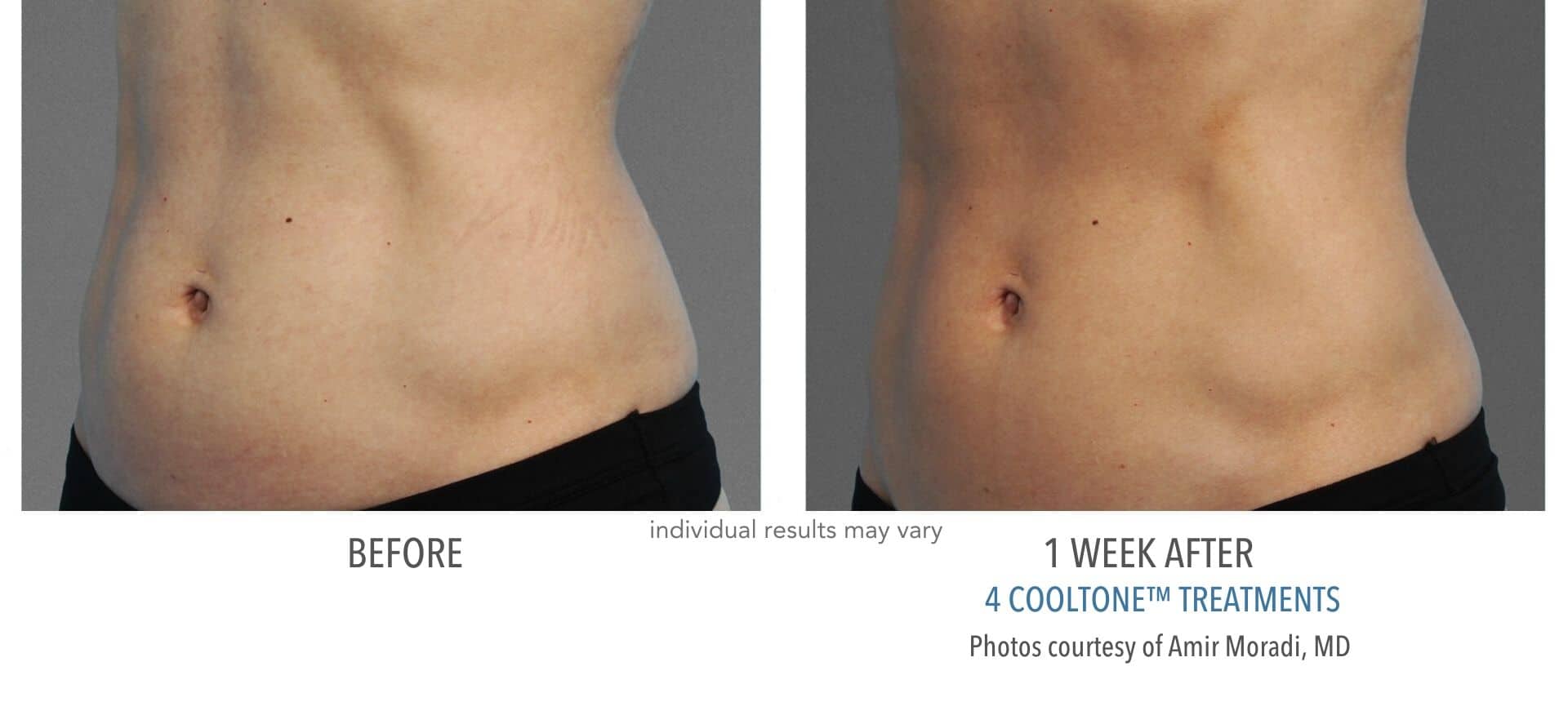 Womans abdomen before and after cooltone at advanced rejuvenation centers.
