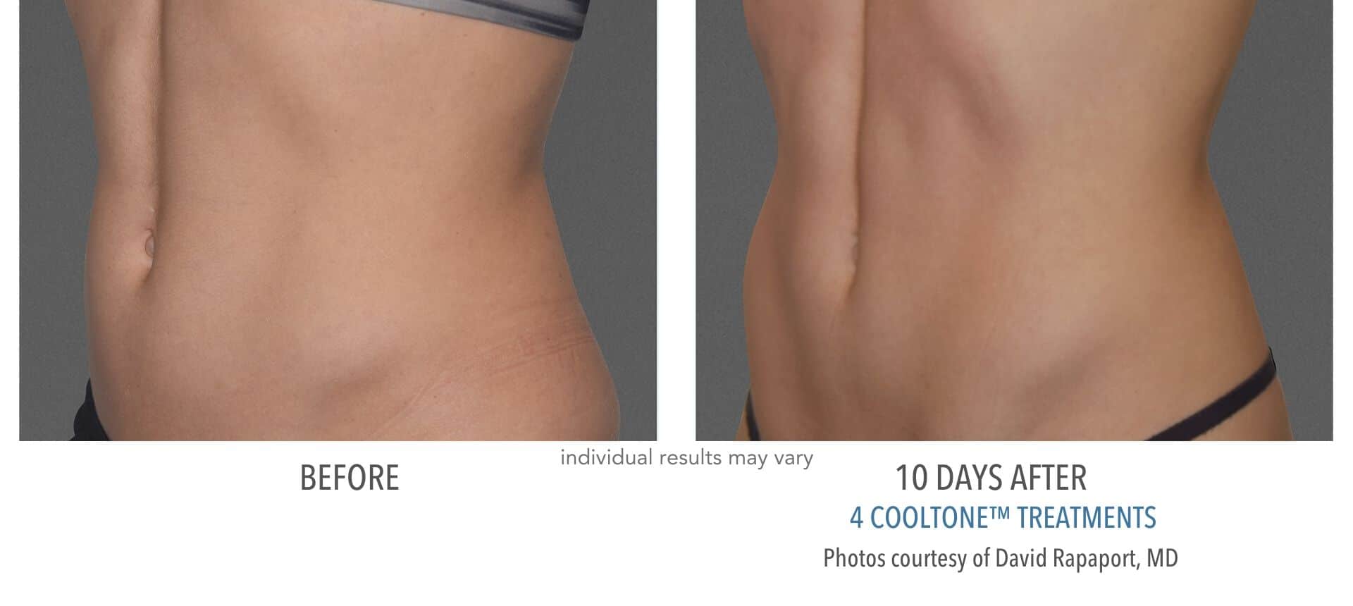 Womans abdomen before and after cooltone treatment at advanced rejuvenation centers.