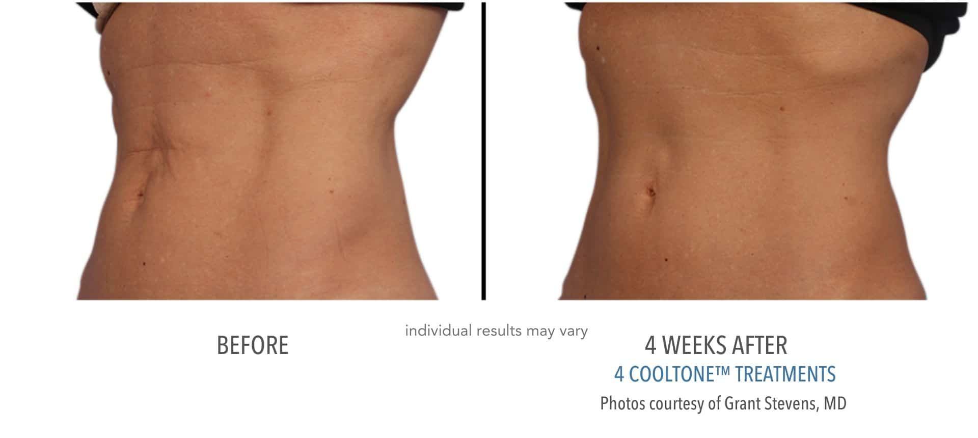 Womans abdomen before and after cooltone treatment at advanced rejuvenation centers.