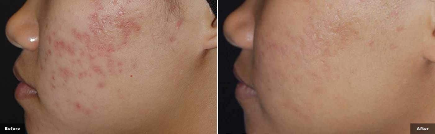 Laser Genesis before and after results at advanced rejuvenation center for improved skin texture and tone in Purchase, NY.