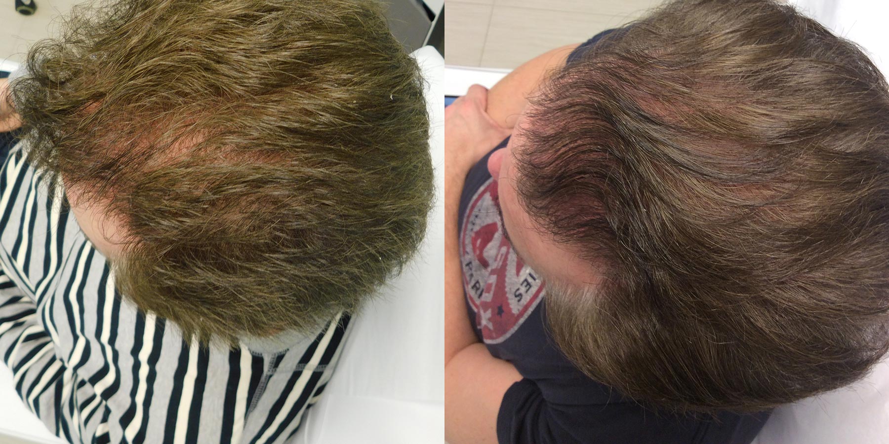 hair restoration