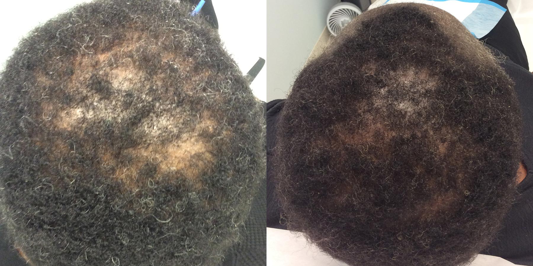 hair restoration