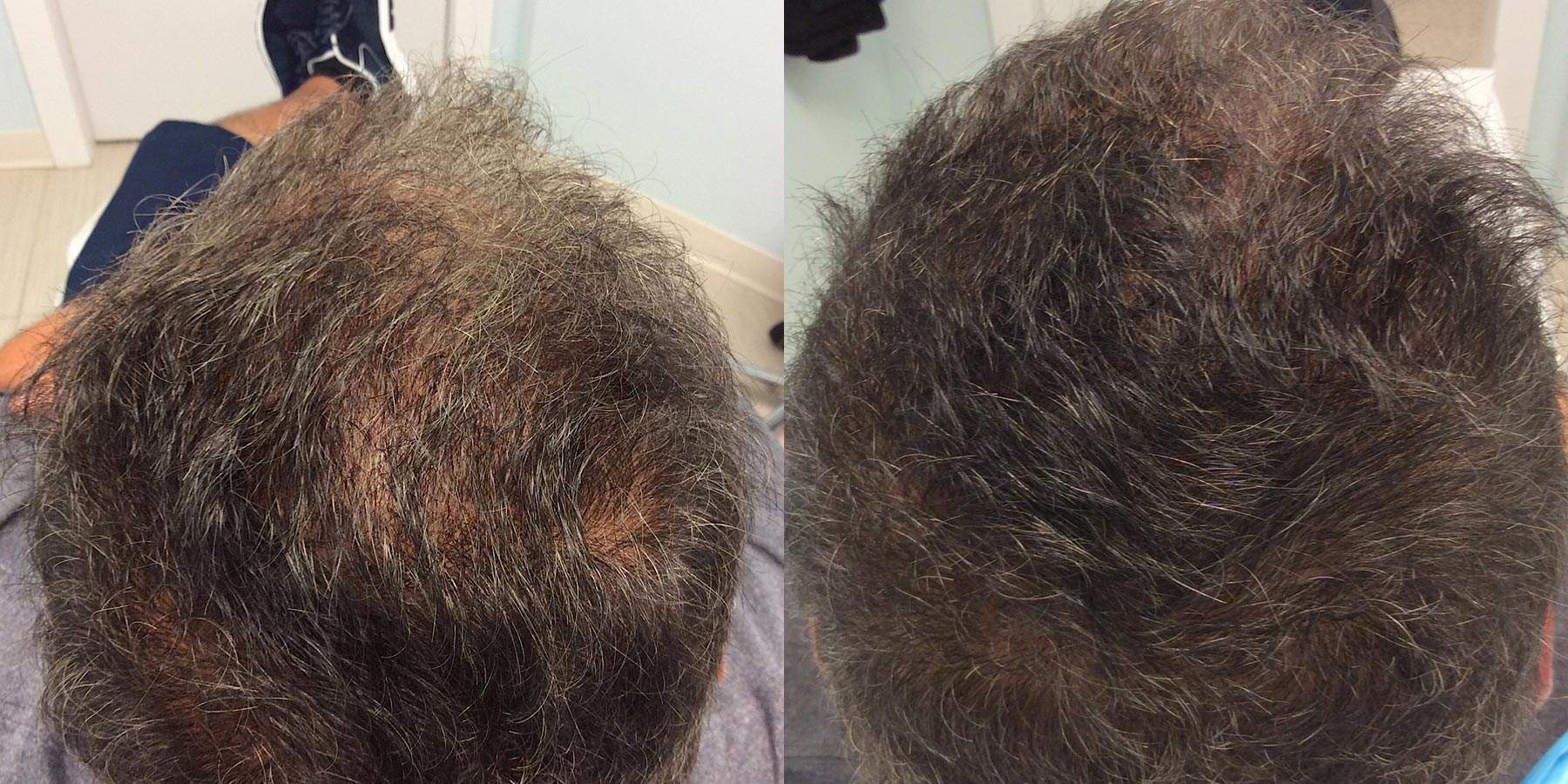 hair restoration