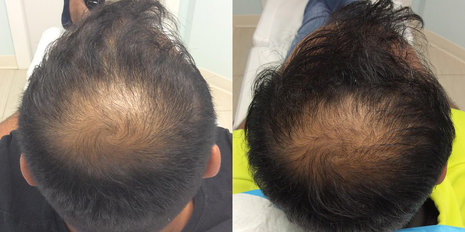 hair restoration