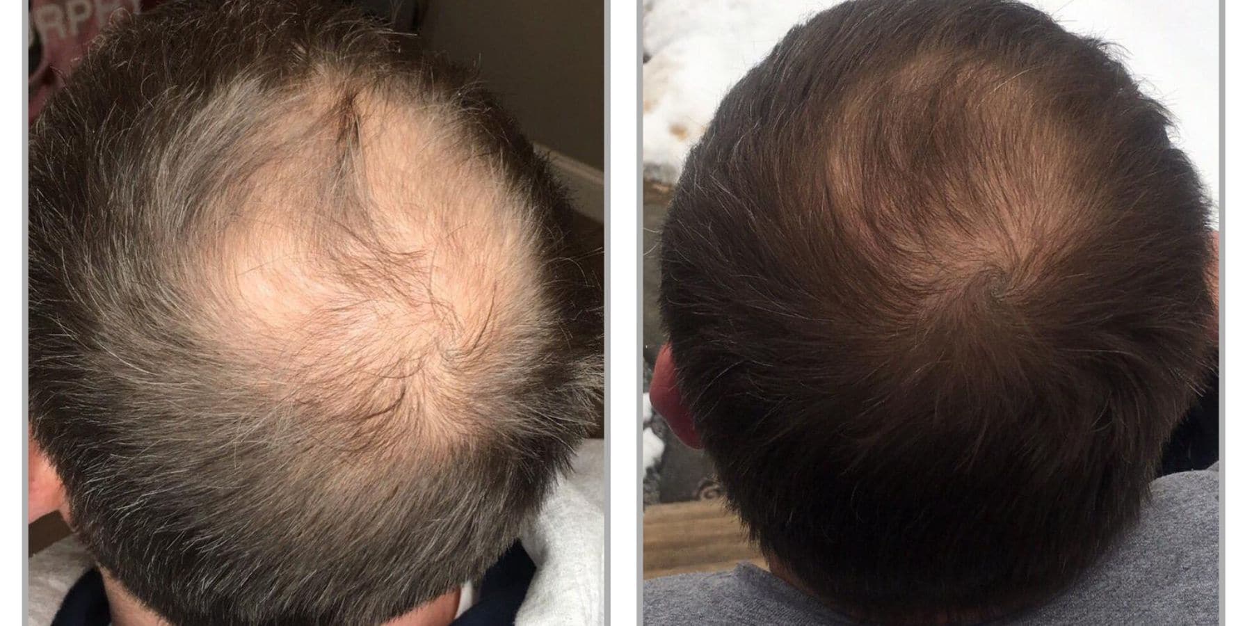 hair restoration