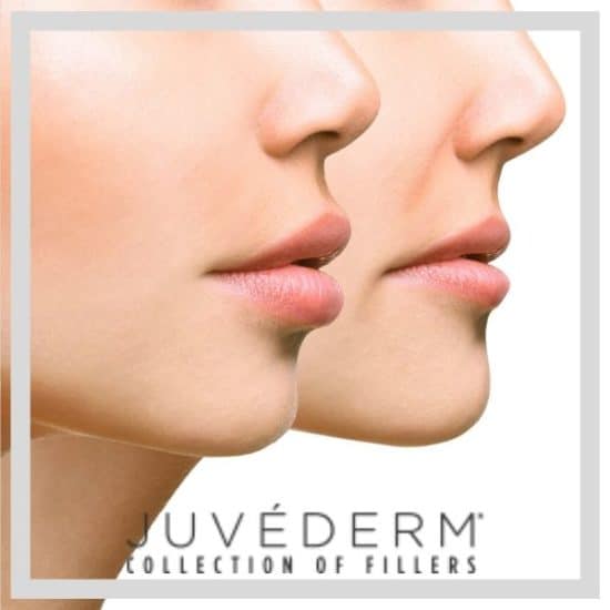 Juvederm and dermal fillers at Advanced Rejuvenation Centers in Purchase, New York.