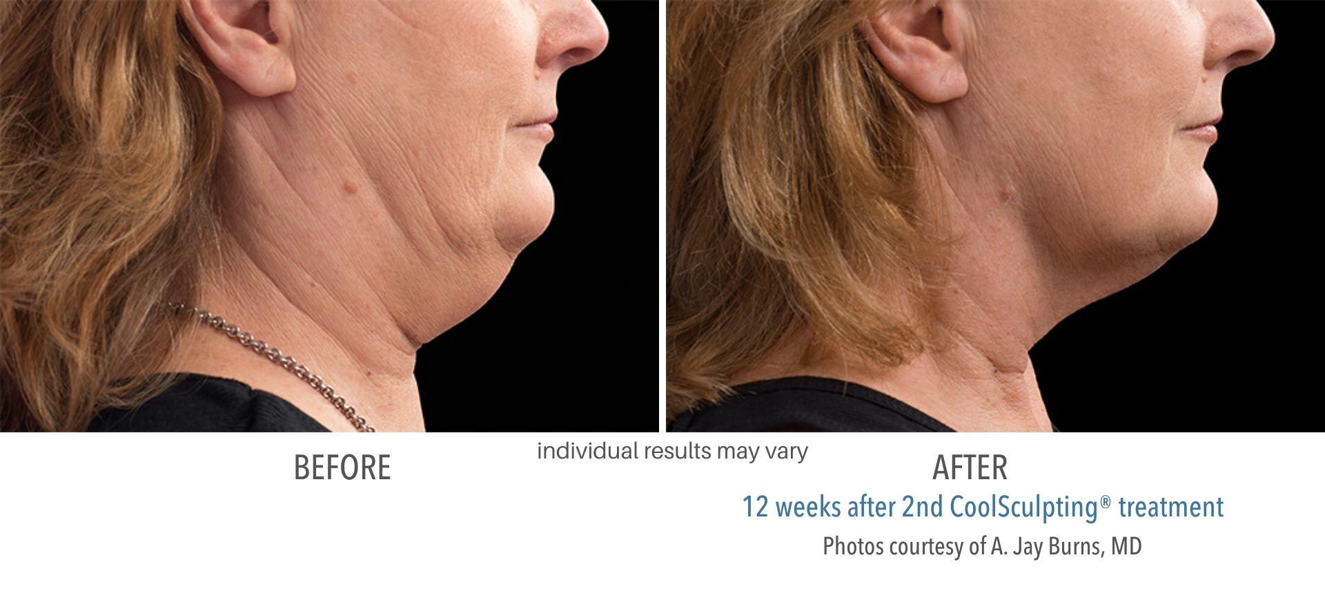 coolsculpting before and after double chin female