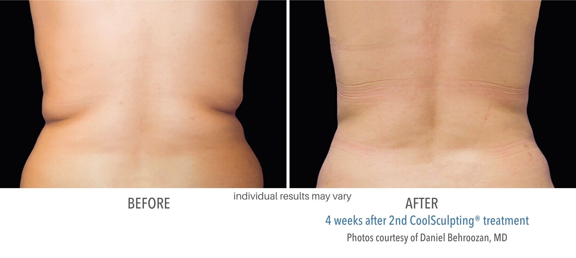 coolsculpting before and after back male