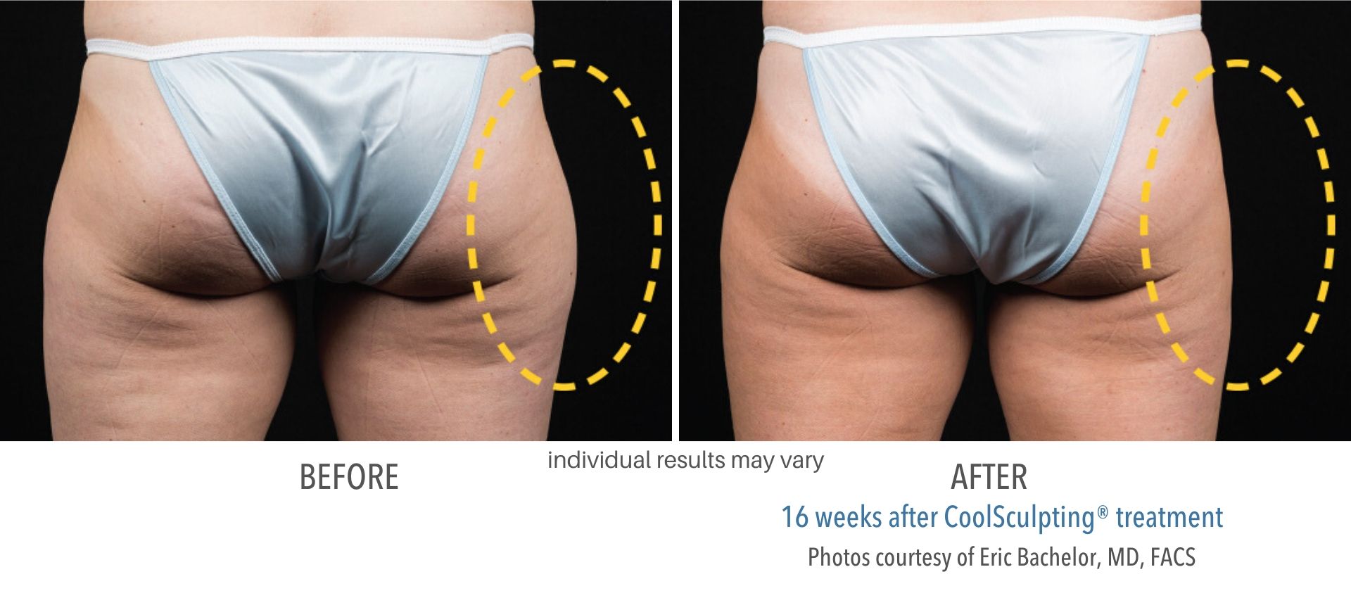 coolsculpting before and after outer thighs