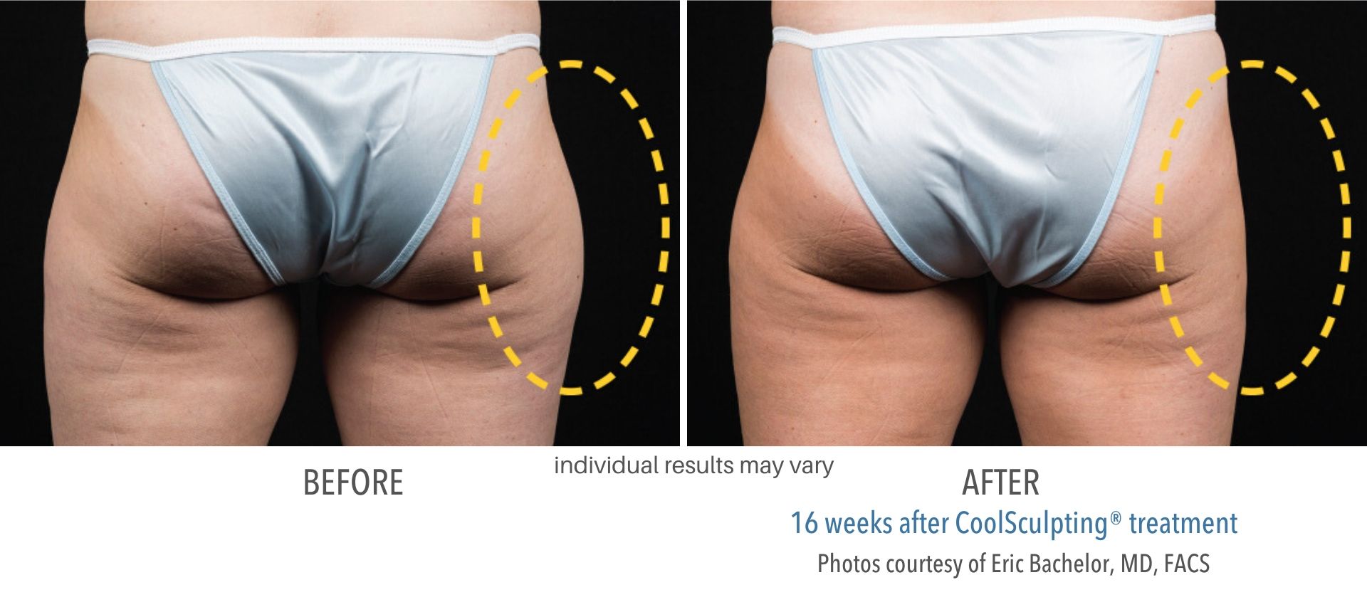 coolsculpting before and after outer thighs