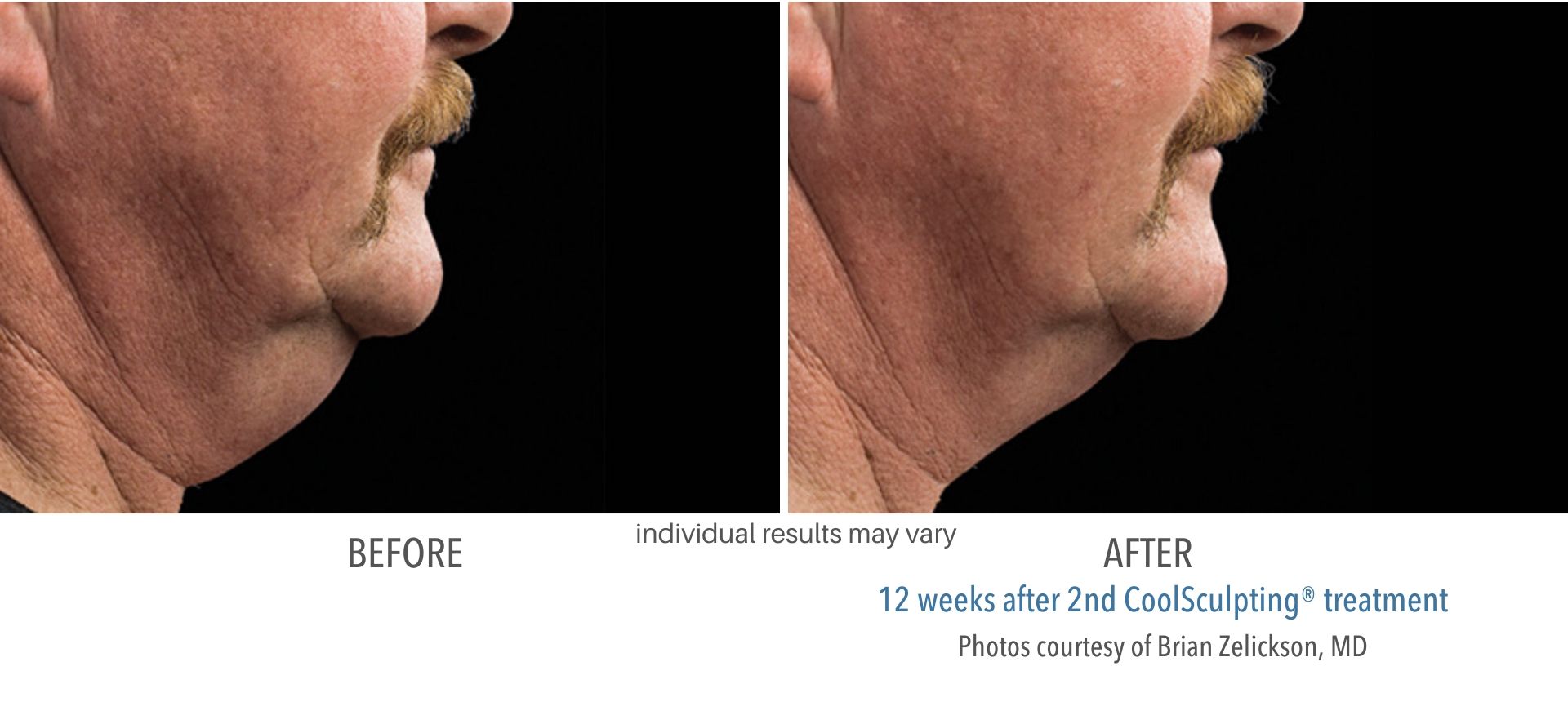 coolsculpting before and after double chin male