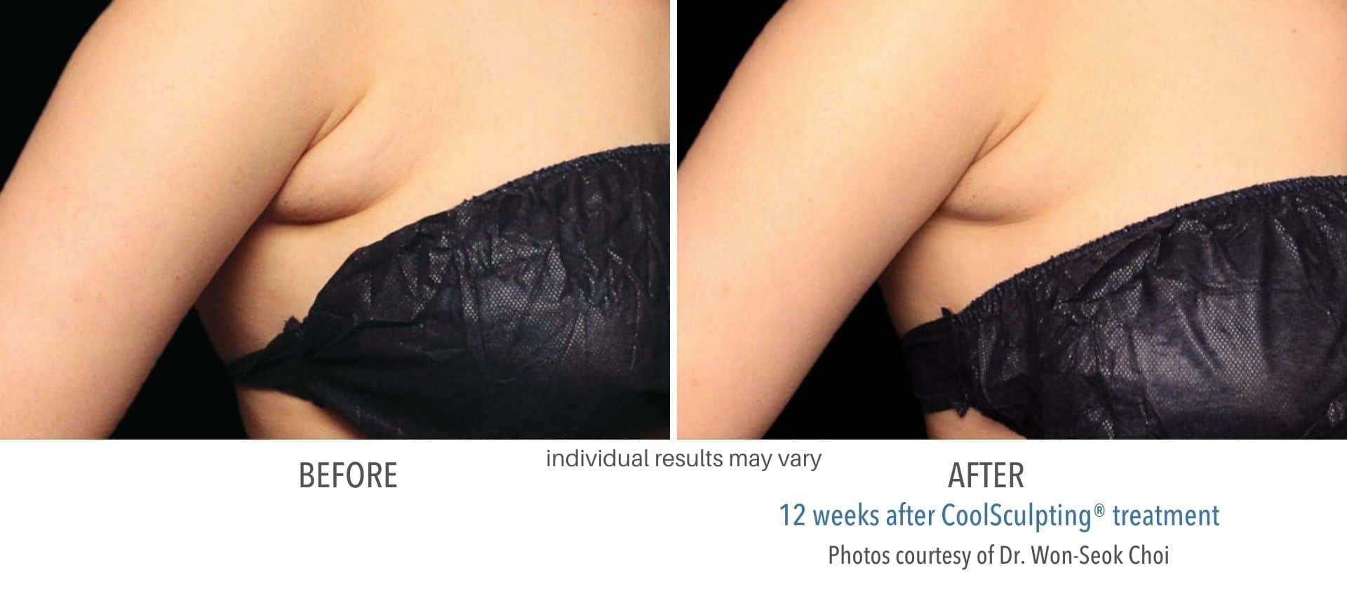 coolsculpting before and after armpit fat