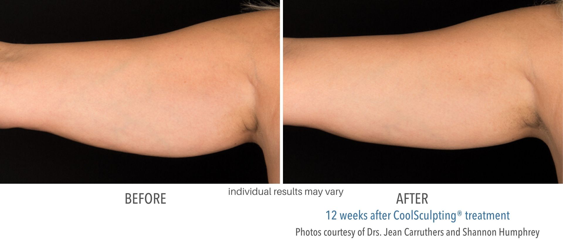 coolsculpting before and after arms