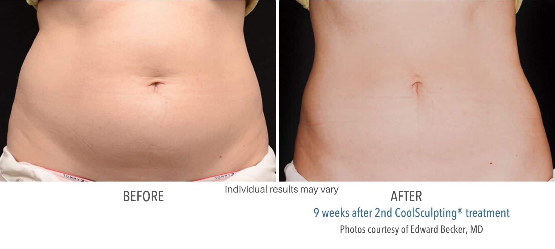 coolsculpting before and after stomach female