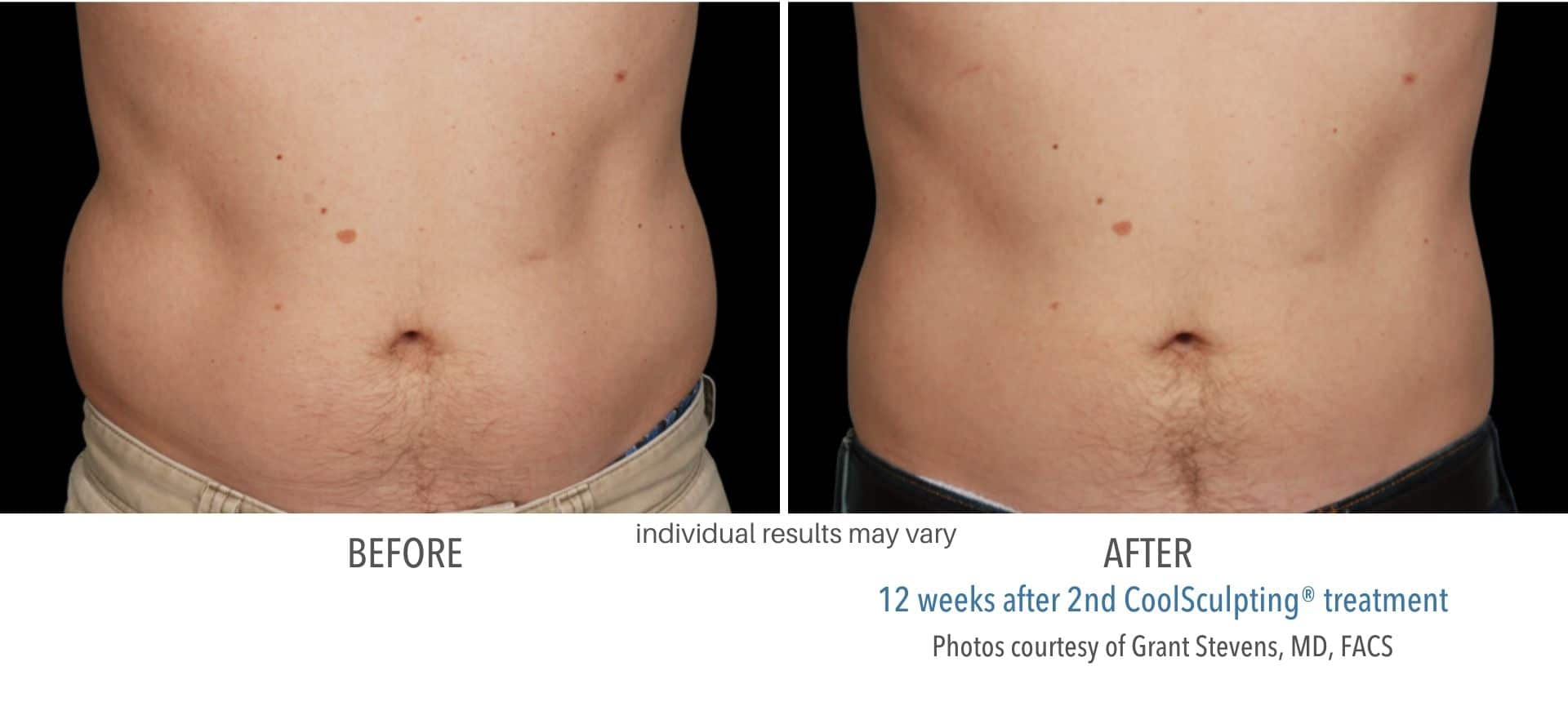 coolsculpting before and after stomach male