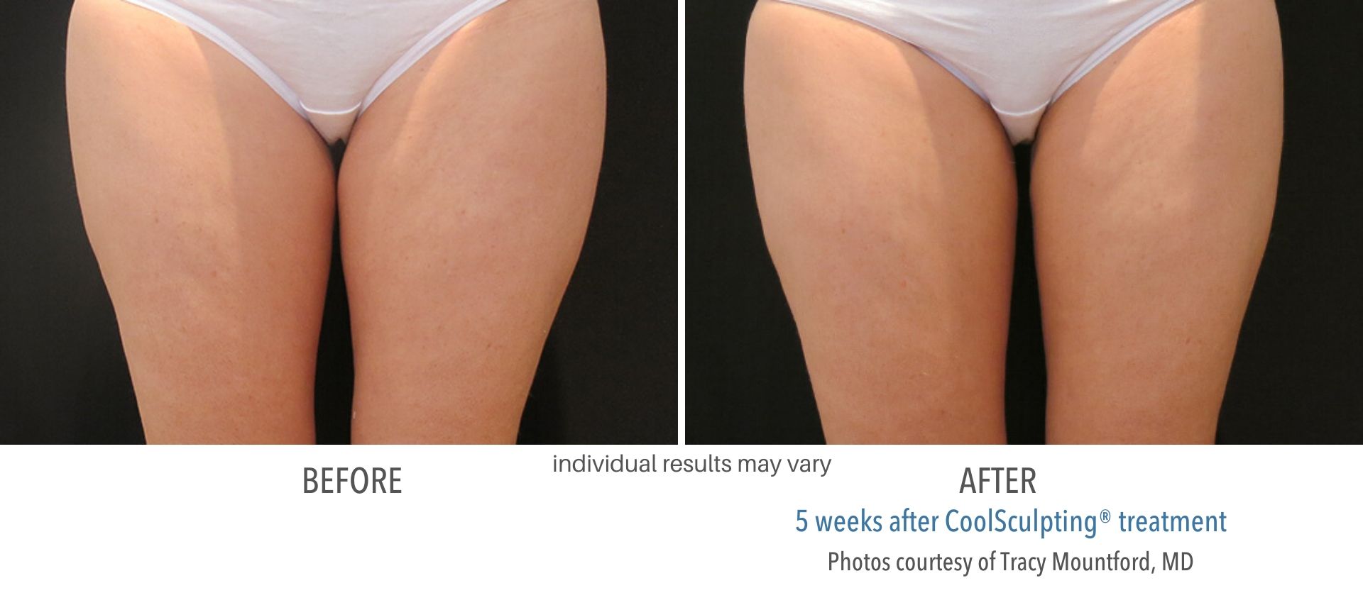 coolsculpting before and after inner thighs