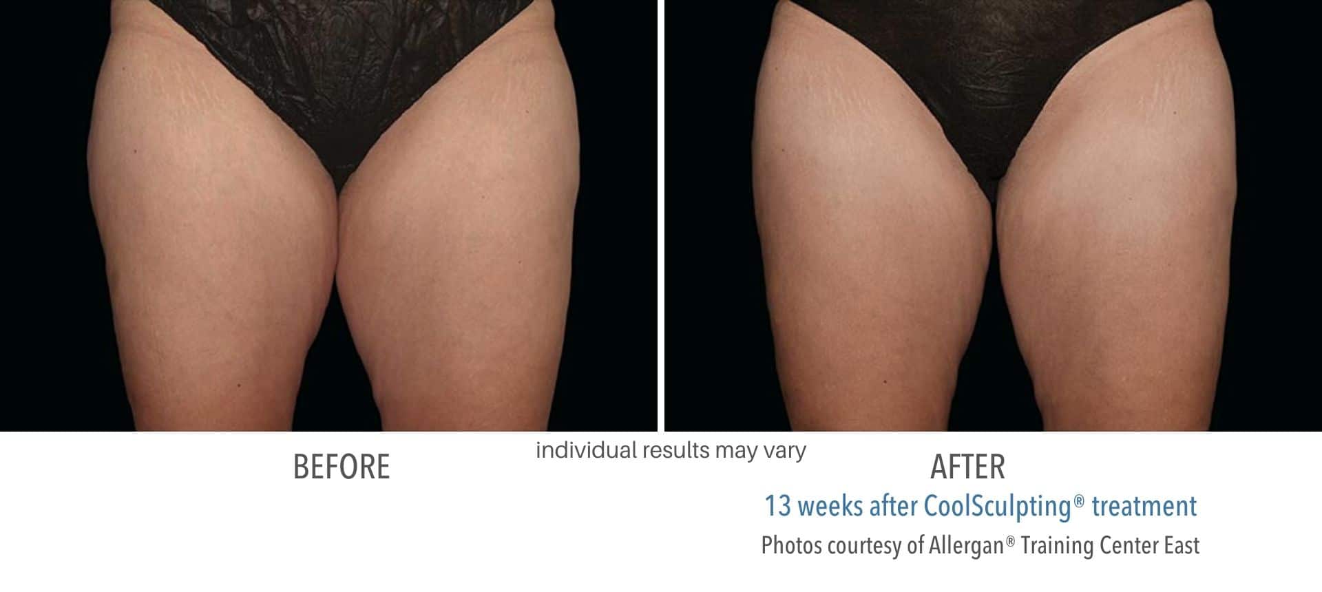 coolsculpting before and after thighs