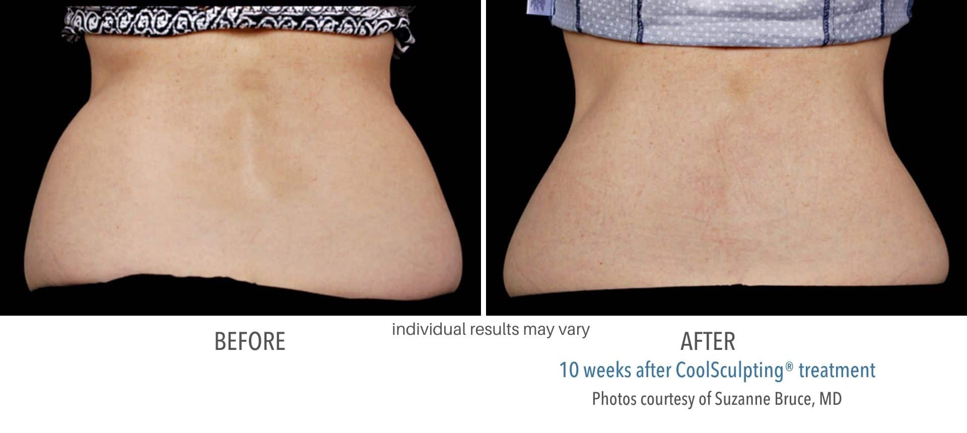 coolsculpting before and after back