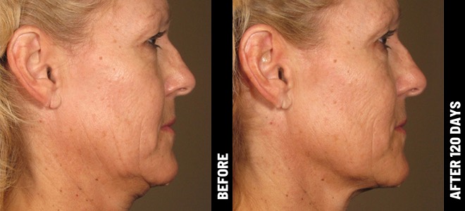 Woman's chin before and after Ultherapy treatment at Advanced Rejuvenation Centers.