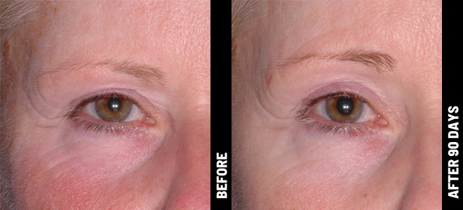 Woman's face before and after Ultherapy treatment at Advanced Rejuvenation Centers.