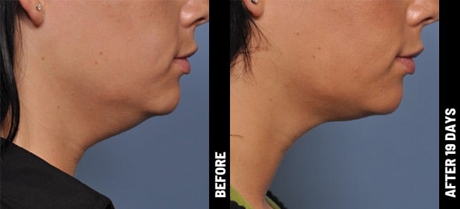 Woman's chin before and after Ultherapy treatment at Advanced Rejuvenation Centers.