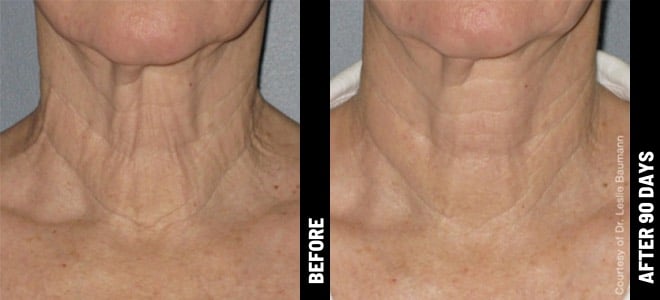 Woman's neck before and after Ultherapy treatment at Advanced Rejuvenation Centers.