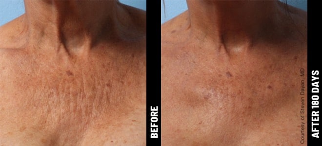 Woman's neck and chest before and after Ultherapy treatment at Advanced Rejuvenation Centers.