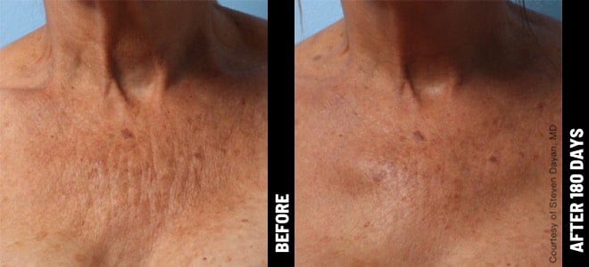 Woman's neck and chest before and after Ultherapy treatment at Advanced Rejuvenation Centers.