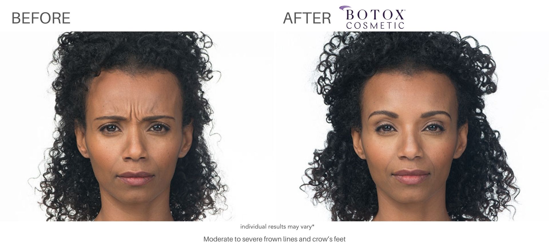 botox treatment with Dr. Saimovici