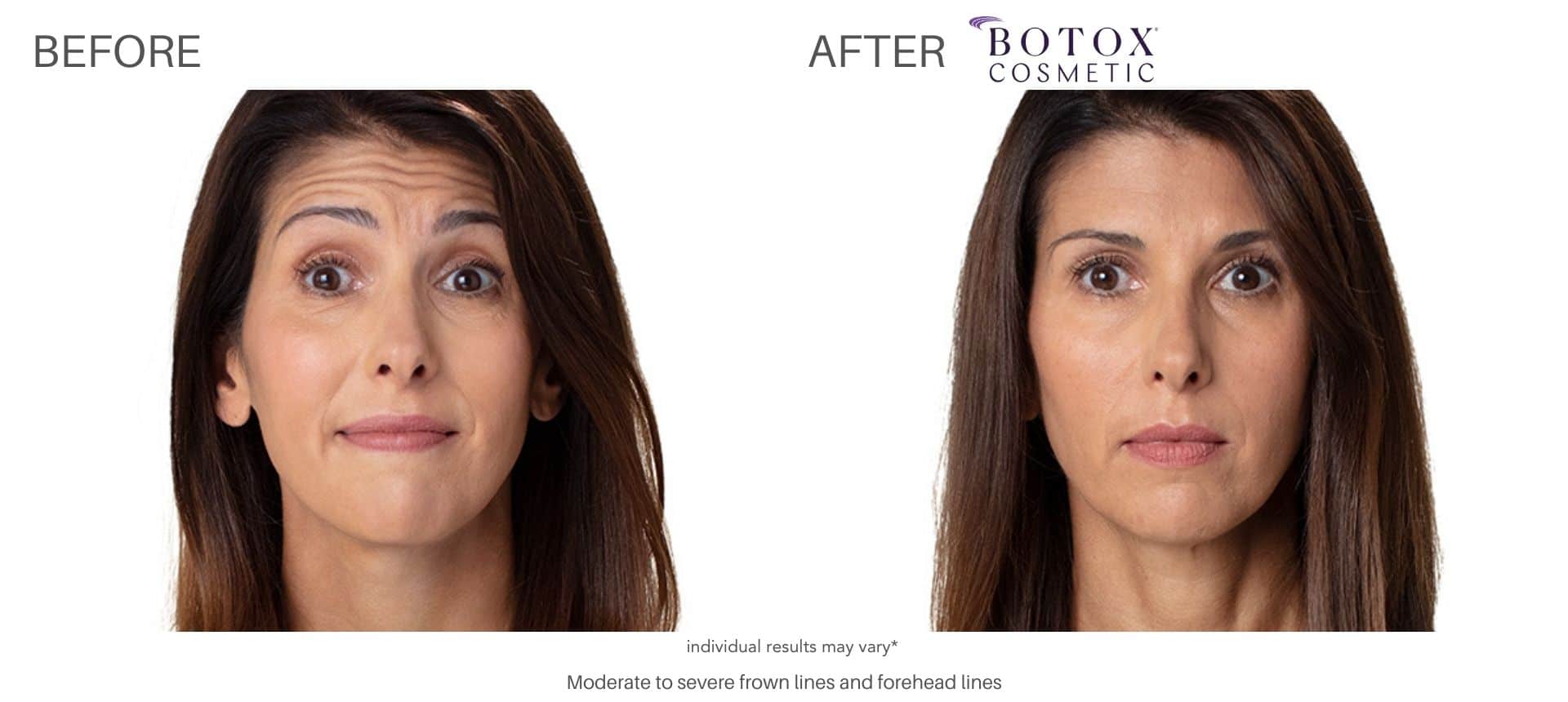 botox cosmetics before and after treatment with Dr. Saimovici