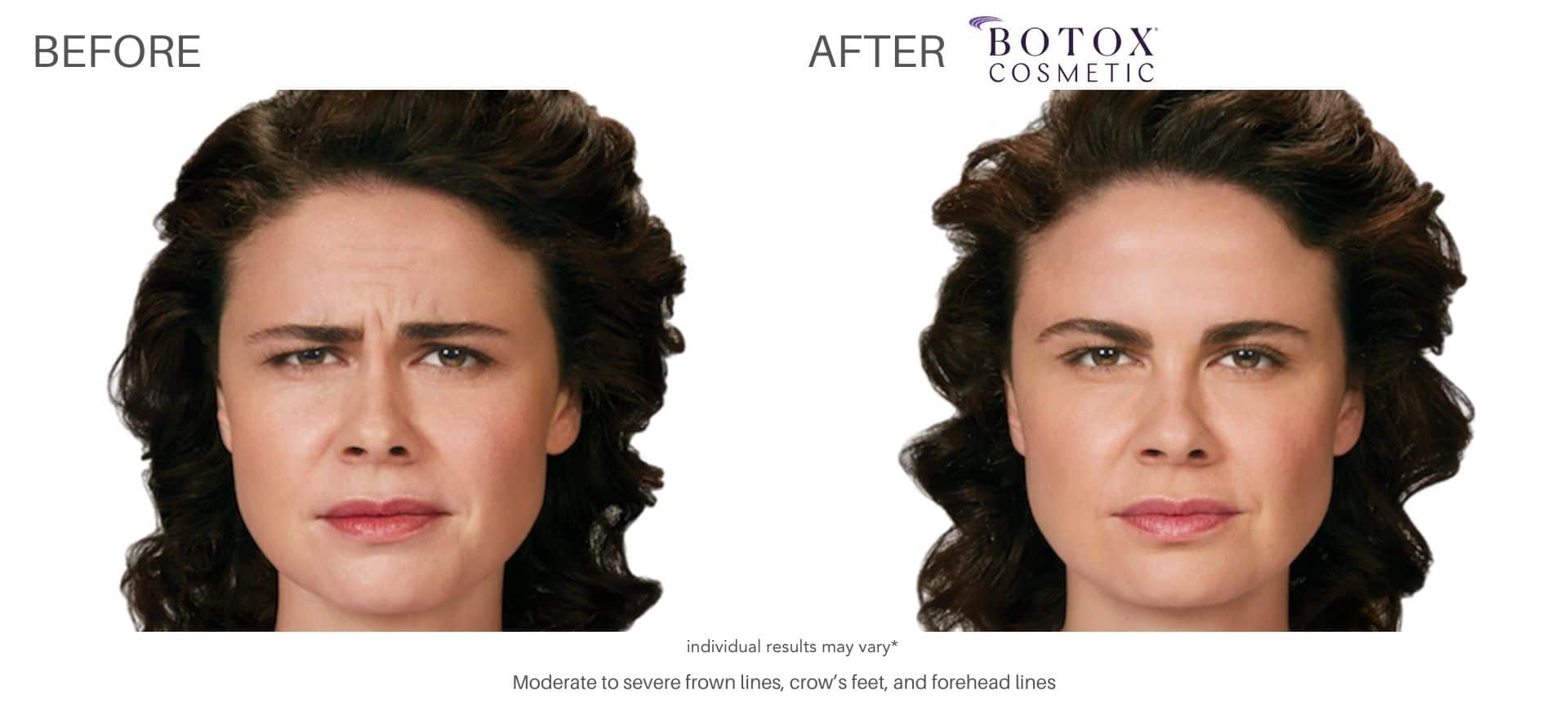 botox injectables before and after treatment with Dr. Saimovici