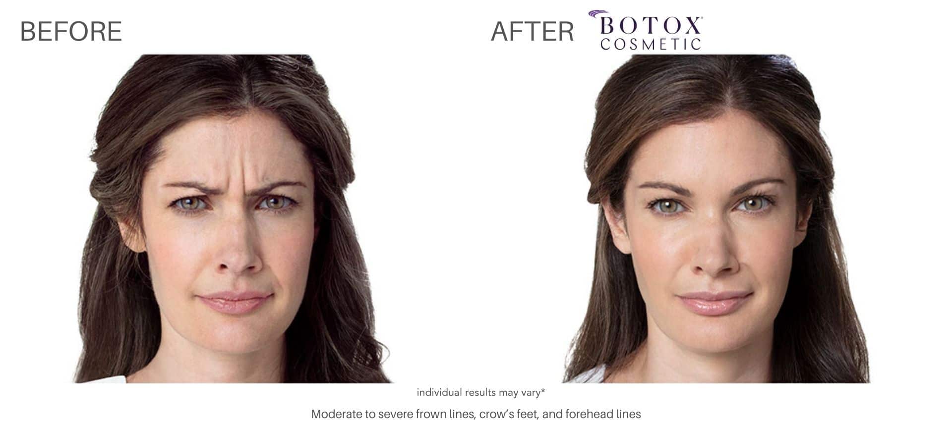 botox cosmetics wrinkle treatment with Dr. Saimovici