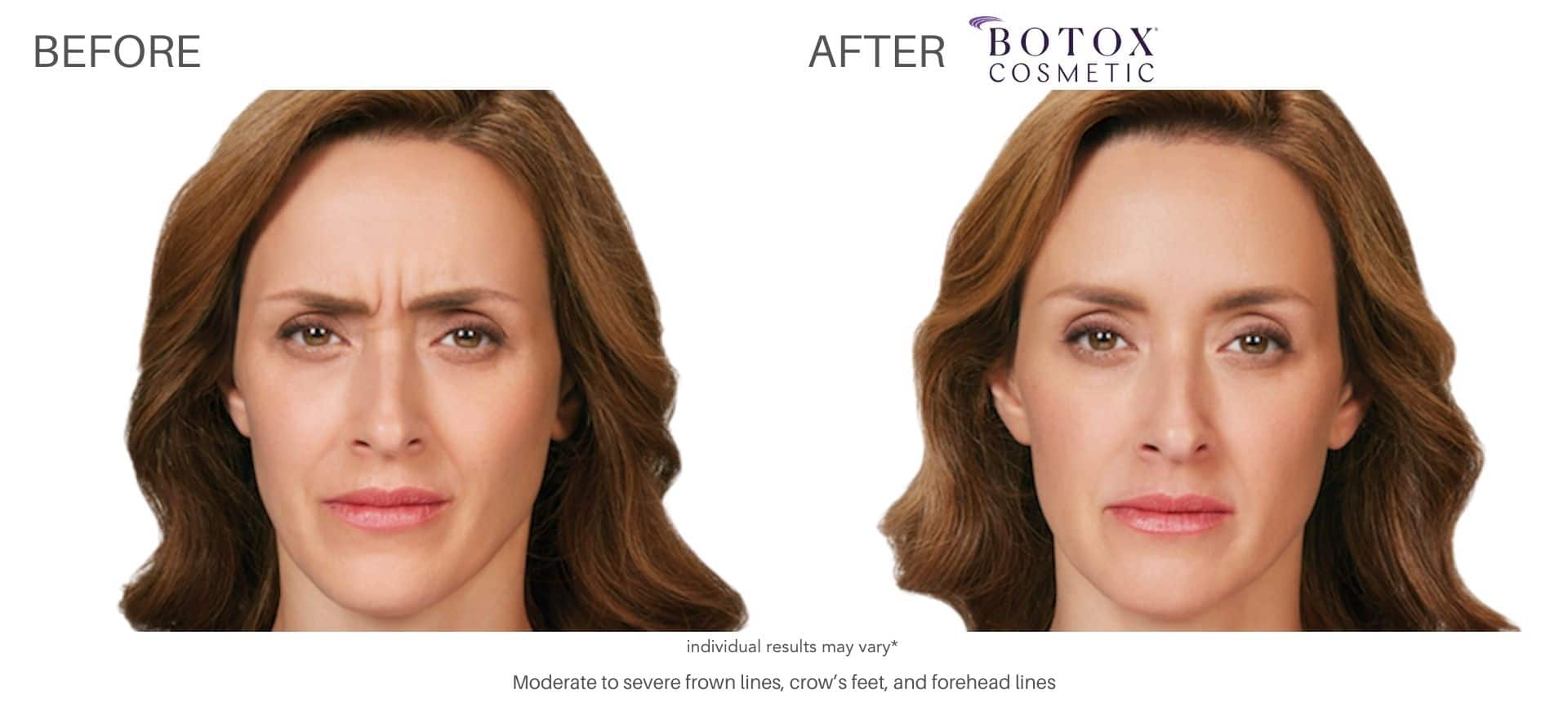 botox treatment in Purchase, NY