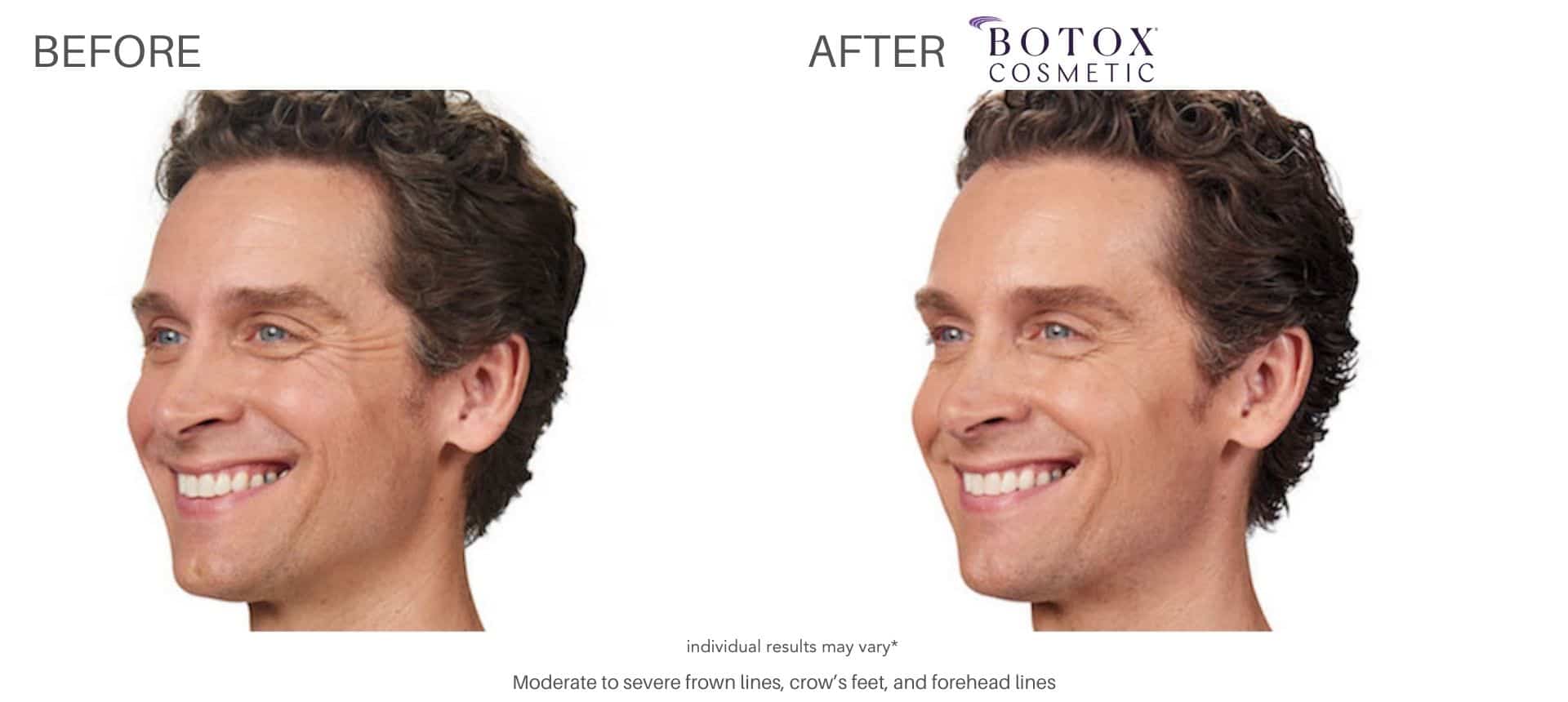 botox treatment at Advanced Rejuvenation Centers