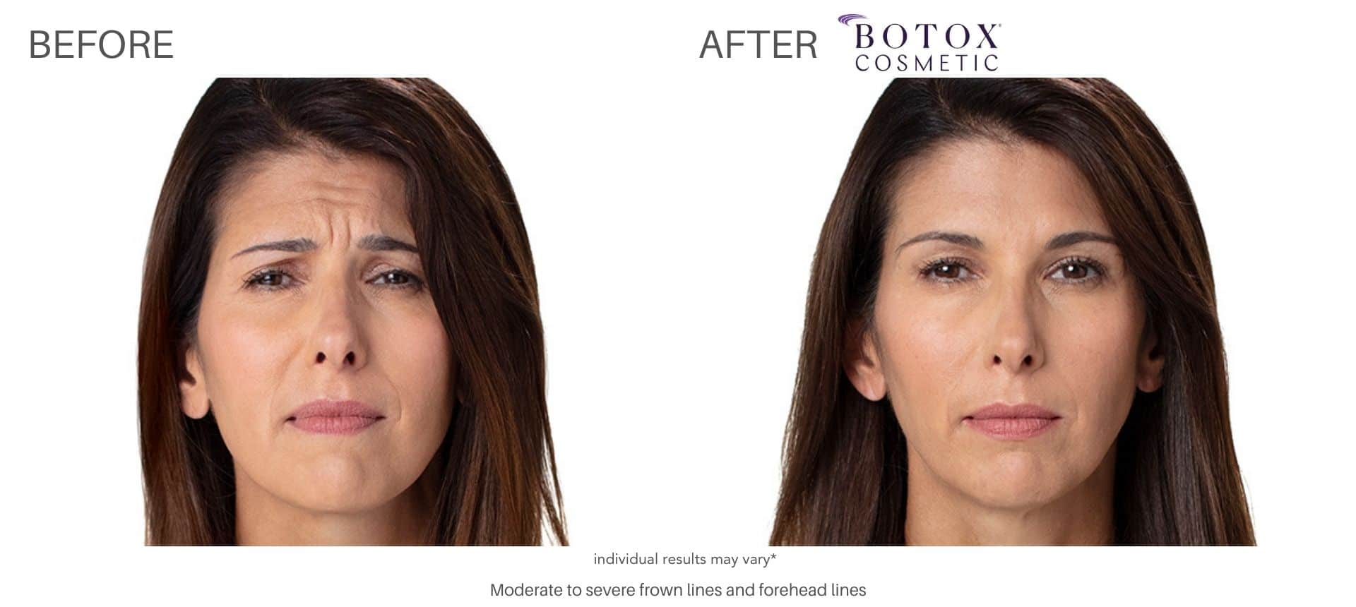 botox treatment in Purchase, NY at Advanced Rejuvenation Centers