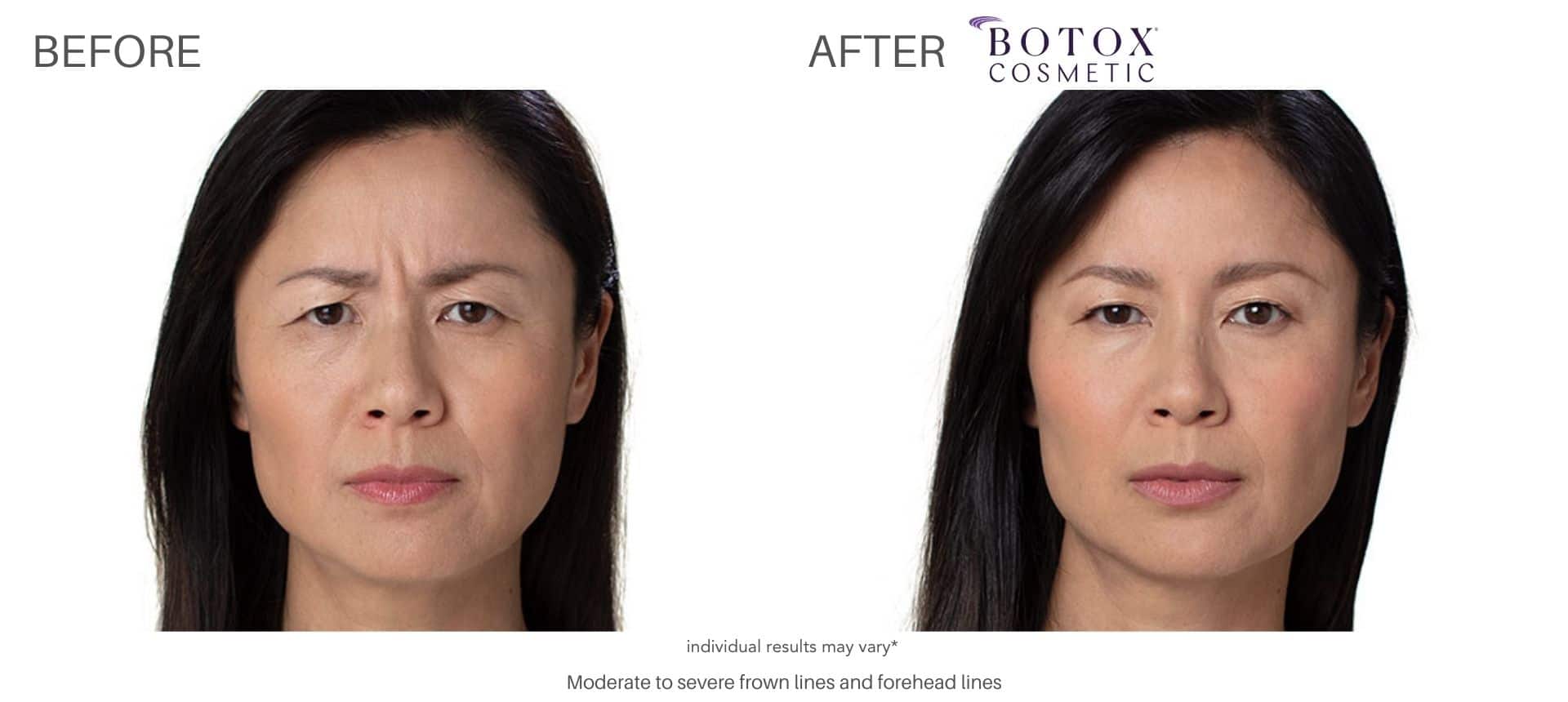 botox treatment with Dr. Saimovici in Purchase, NY