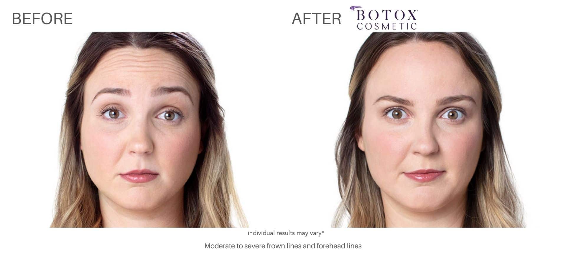 botox real results with Dr. Saimovici