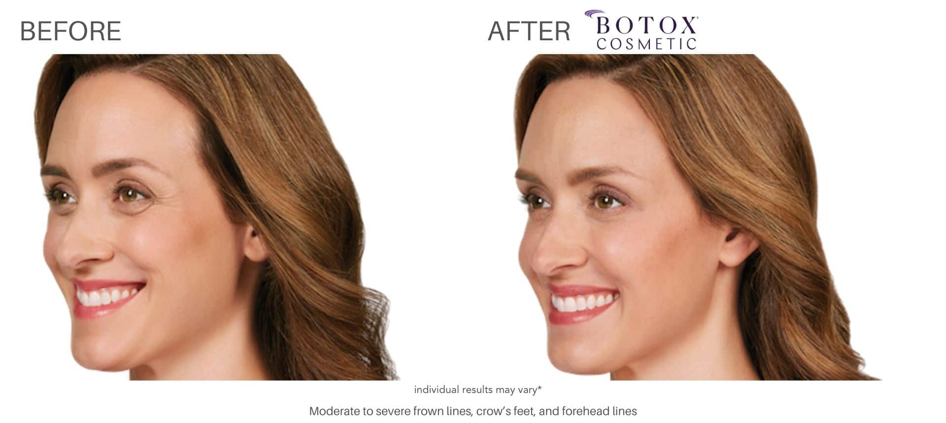 botox free consultation with Dr. Saimovici